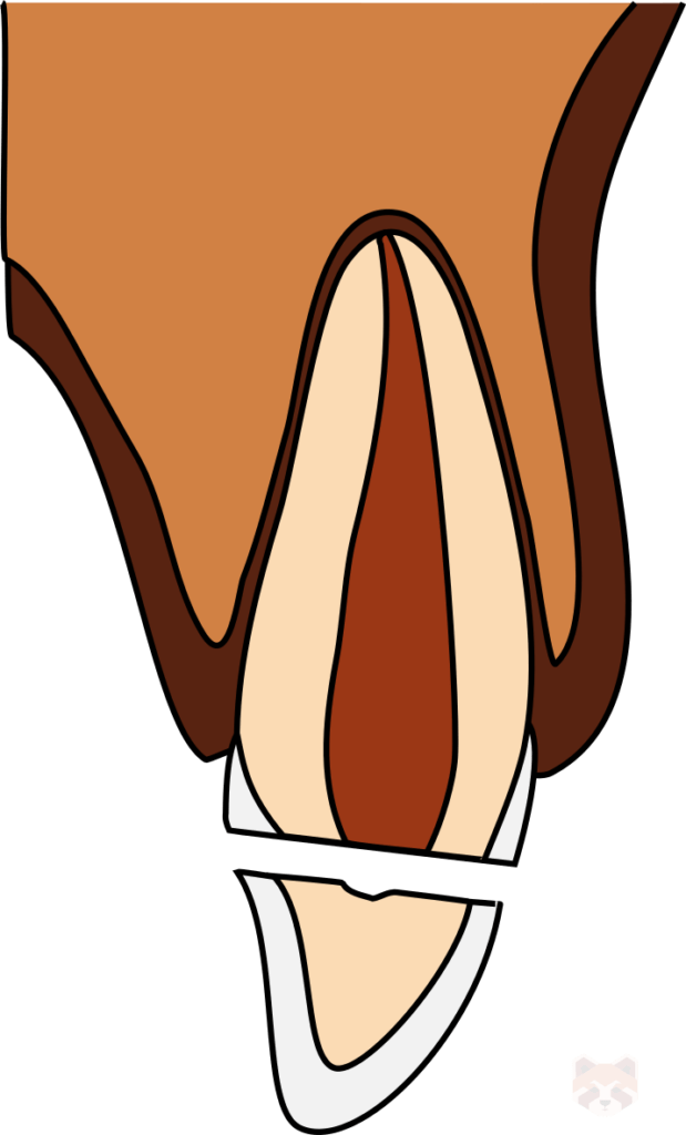 Complicated crown fracture 1