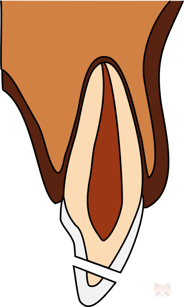 Uncomplicated crown fracture 1