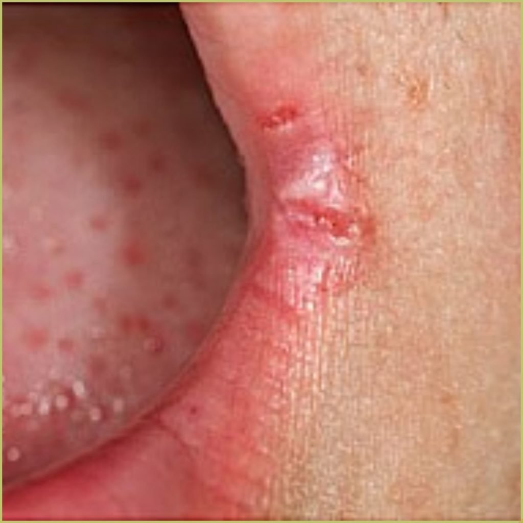 280x190 angular cheilitis ref guide orig 2 1024x1024 1