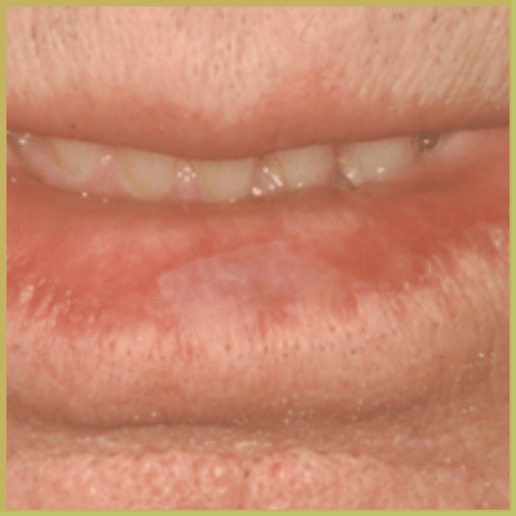 Actinic cheilitis 1 4 1024x1024 1