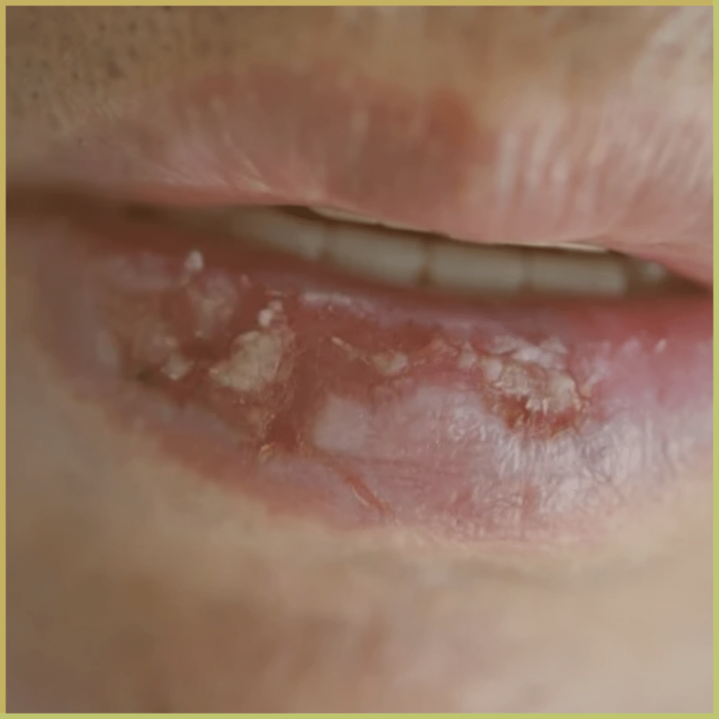 Actinic cheilitis 2 4 1024x1024 1