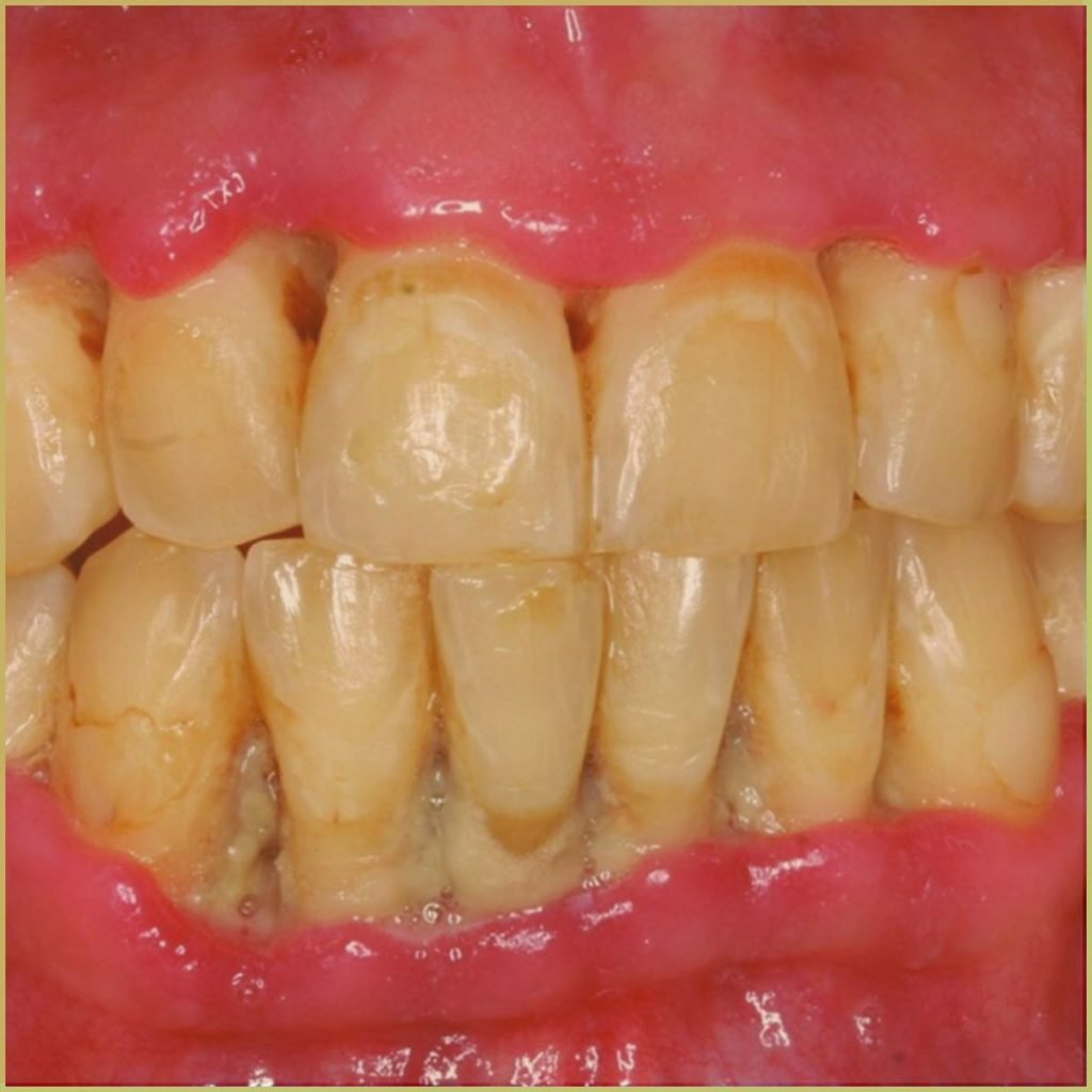 Acute Necrotizing Ulcerative Gingivitis 1 1024x1024 1