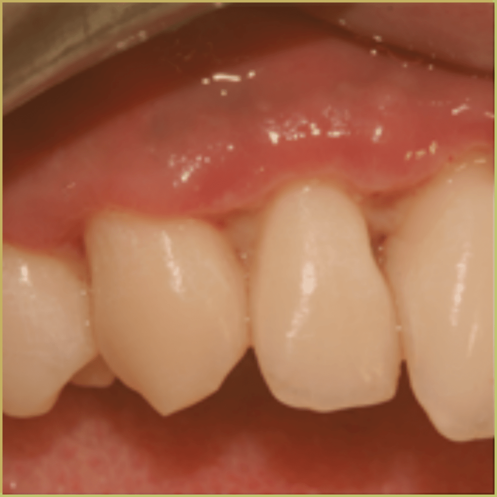 Acute Necrotizing Ulcerative Gingivitis 2 1024x1024 1