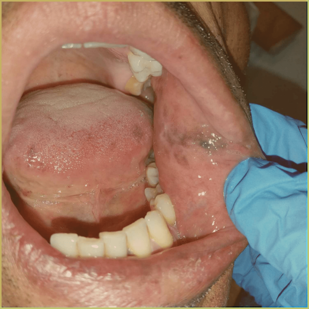 Addisons Disease 1 1024x1024 1