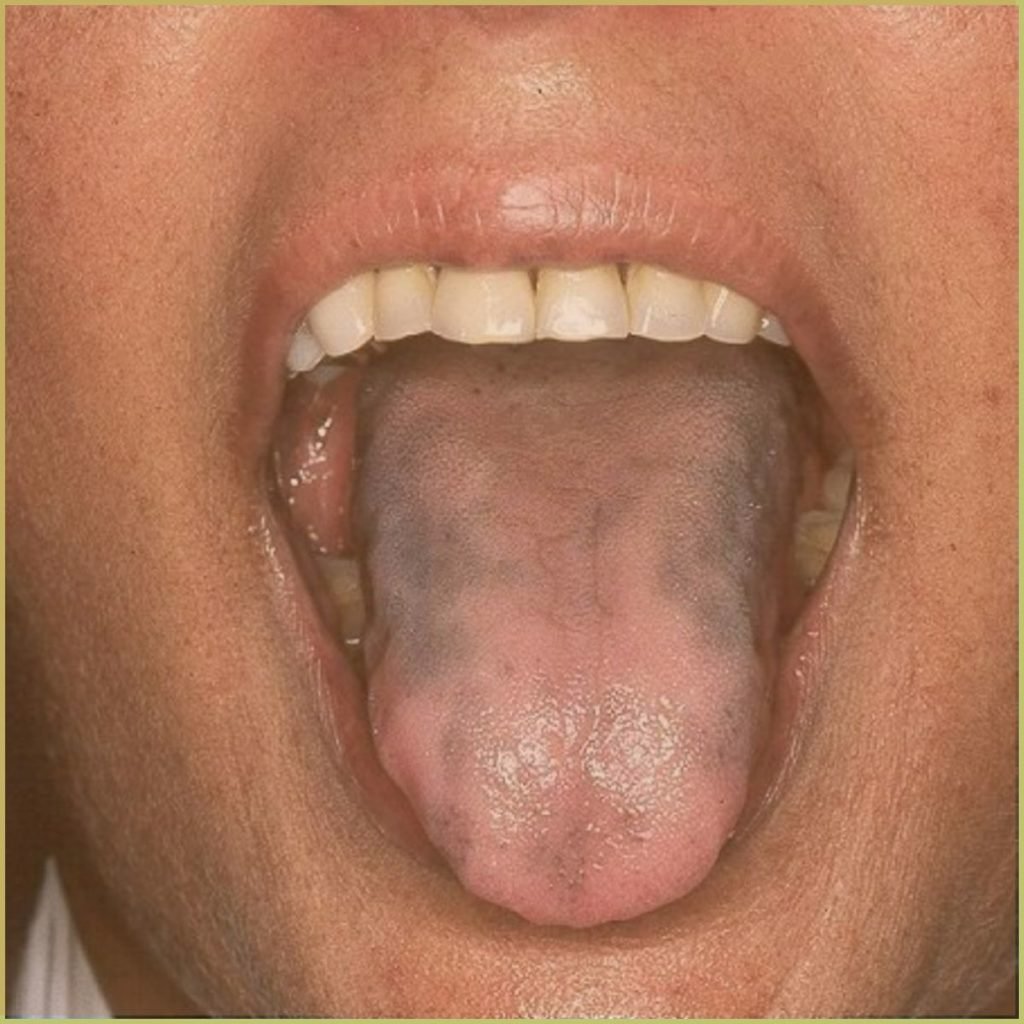 Addisons Disease 2 1024x1024 1