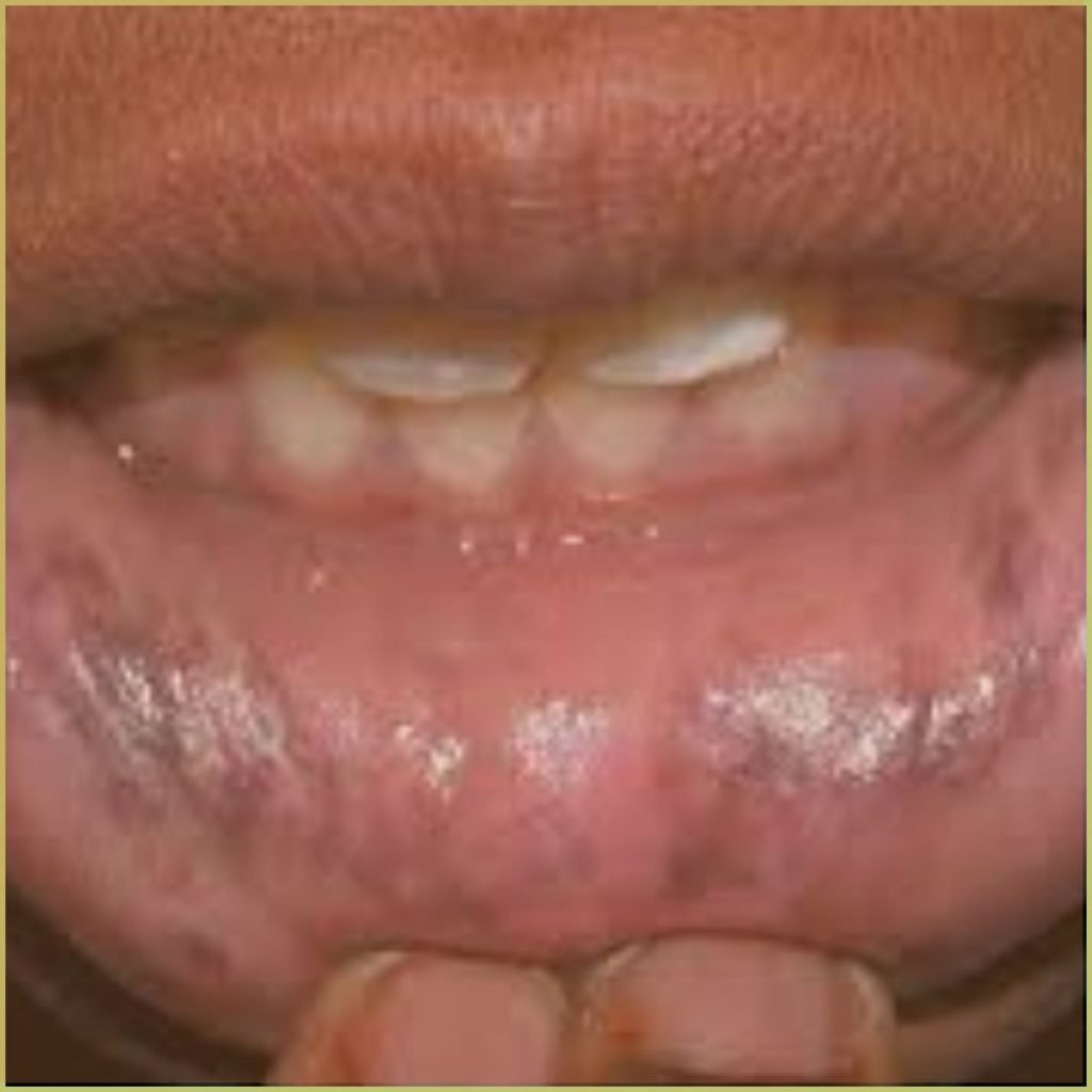 Addisons Disease 3 1024x1024 1