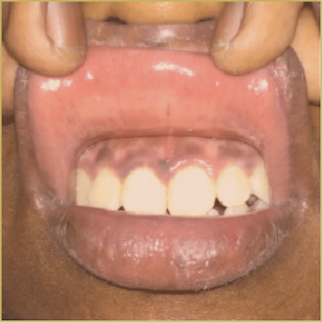 Addisons Disease 4 1024x1024 1