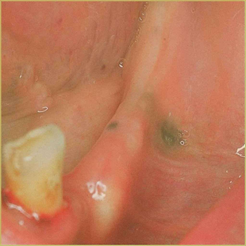 Amalgam Tattoo 4 1024x1024 1