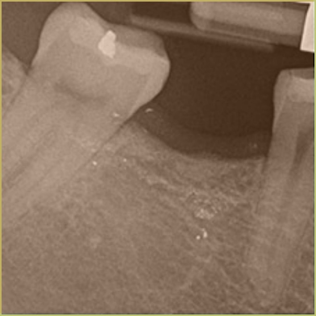 Amalgam Tattoo 5 1024x1024 1