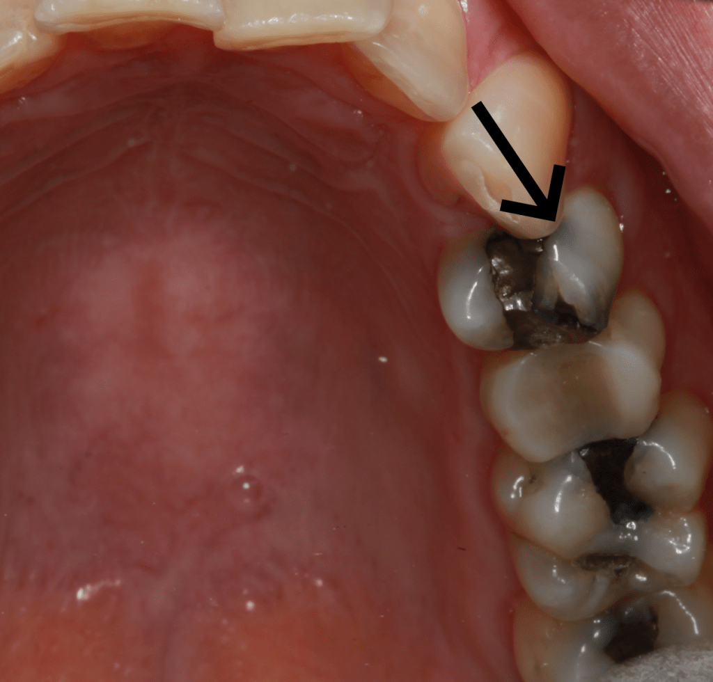 Amalgam blues cropped arrow 2 1024x980 1