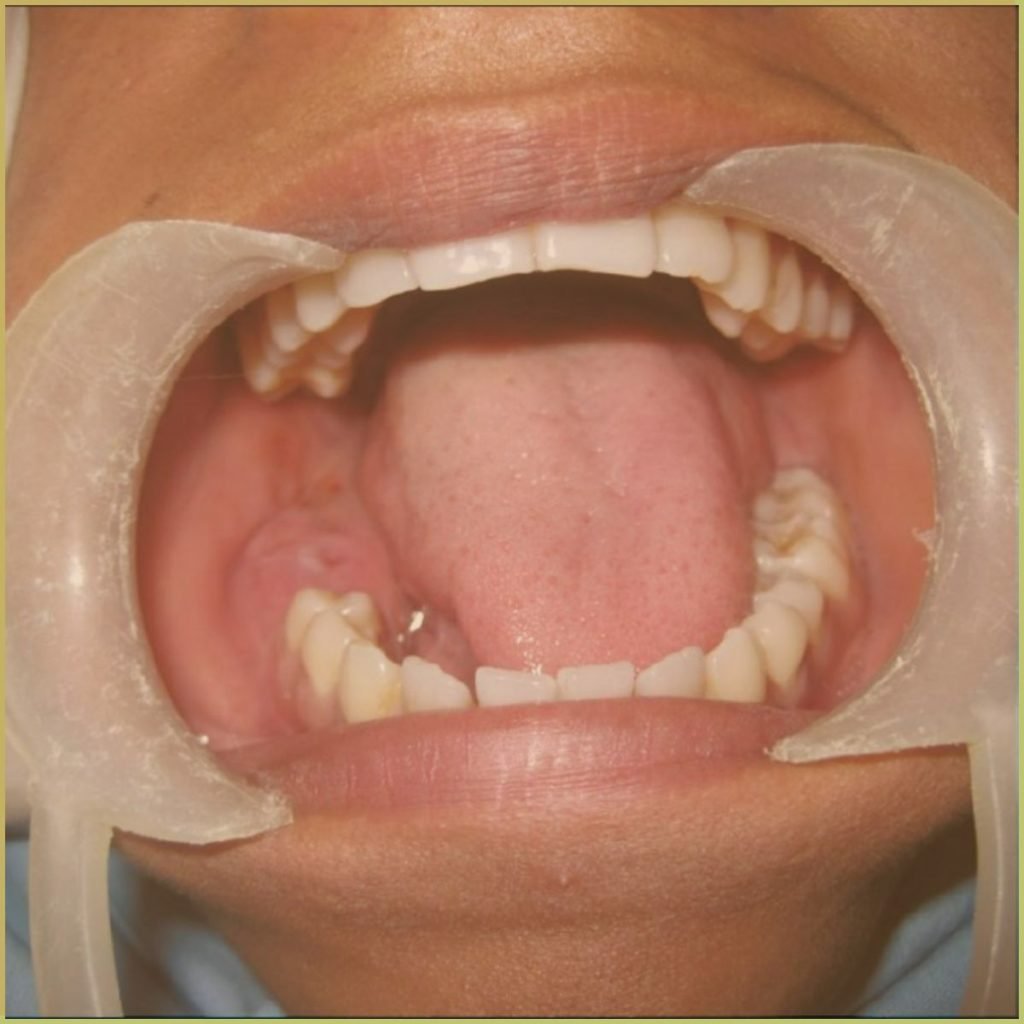 Ameloblastic Fibroma 1 1024x1024 1