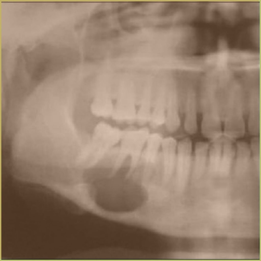 Ameloblastic Fibroma 2 1024x1024 1