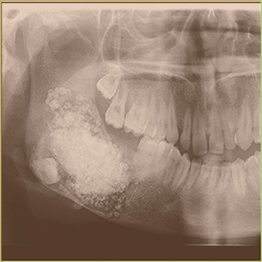 Ameloblastic Fibroma 3 1024x1024 1