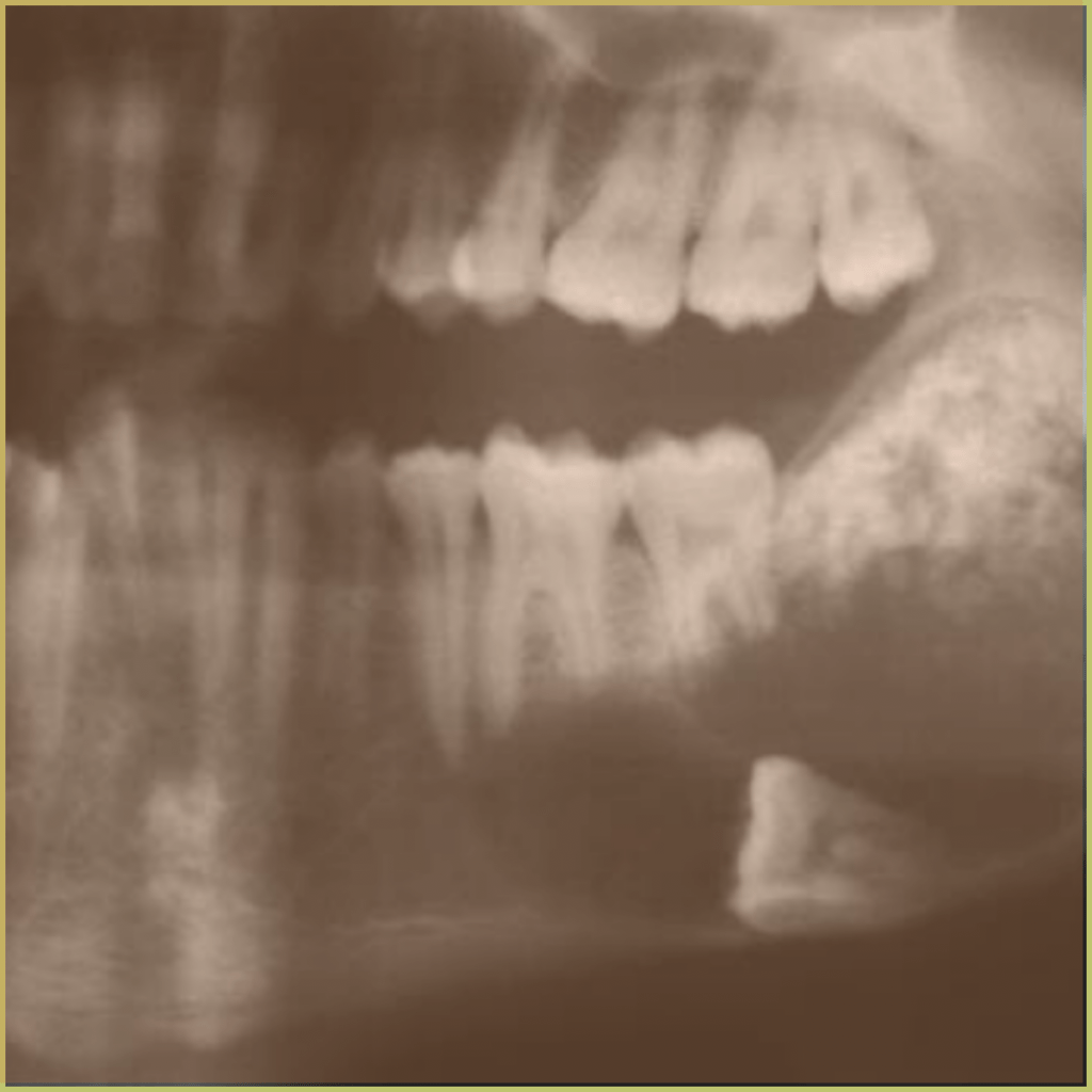 Ameloblastic Fibroma 4 1024x1024 1