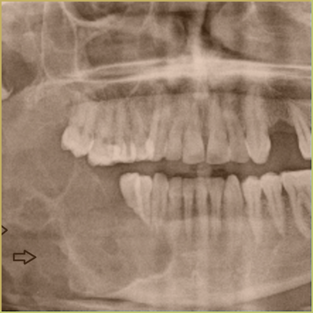 Ameloblastoma 1 1024x1024 1
