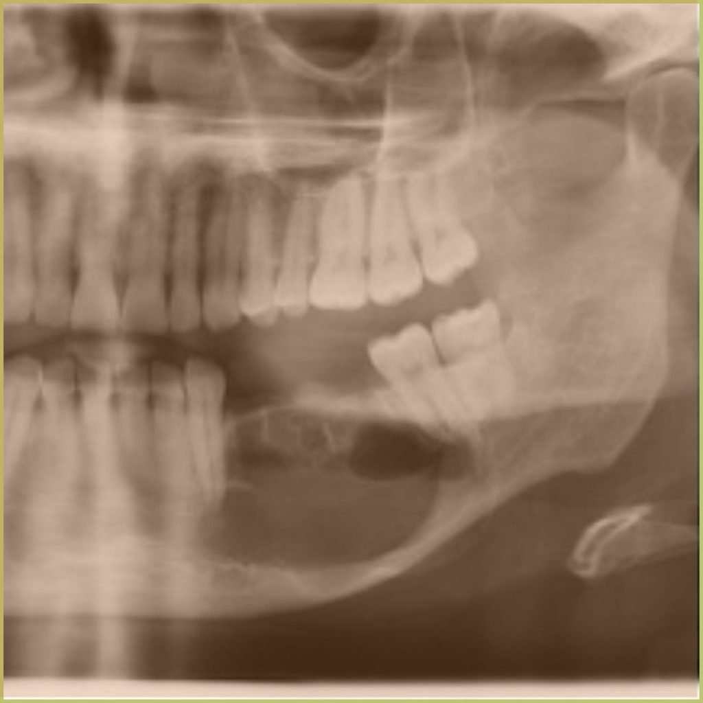 Ameloblastoma 2 1024x1024 1