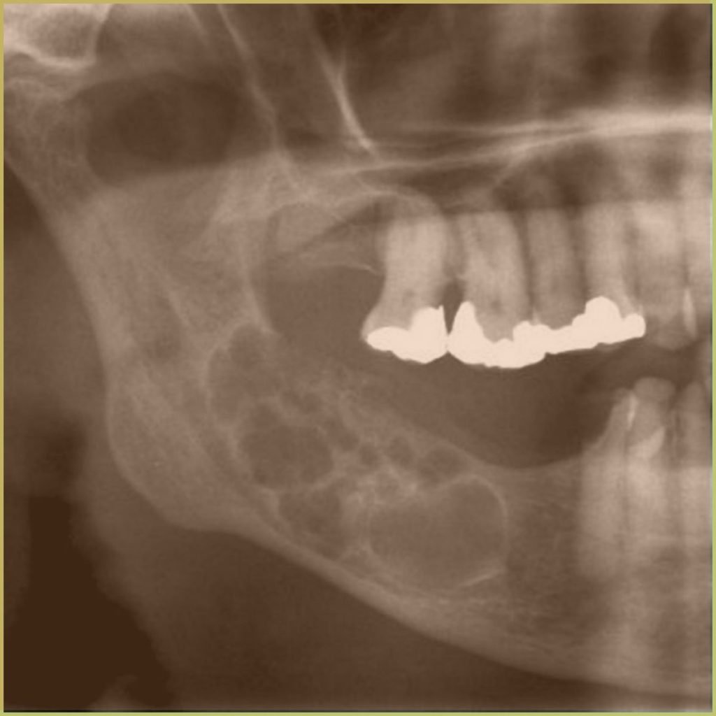 Ameloblastoma 3 1024x1024 1
