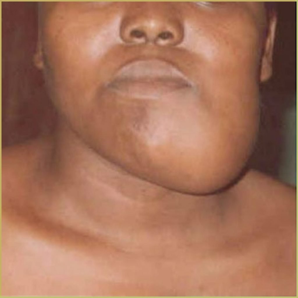 Ameloblastoma 4 1024x1024 1