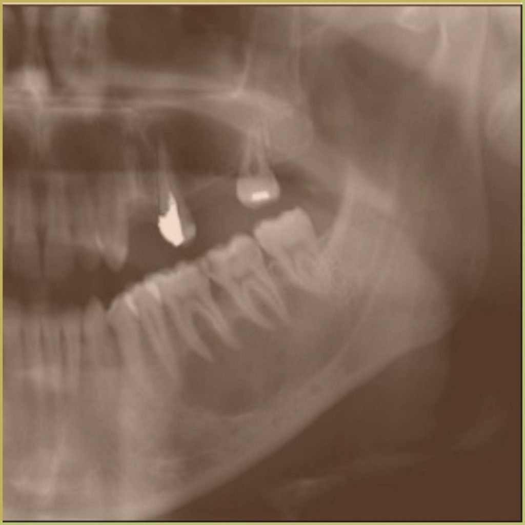 Aneurysmal Bone Cysts 1 1024x1024 1