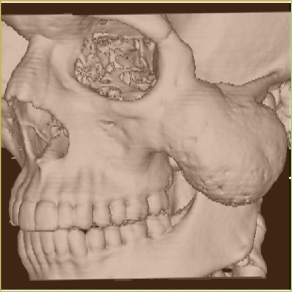 Aneurysmal Bone Cysts 2 1024x1024 1