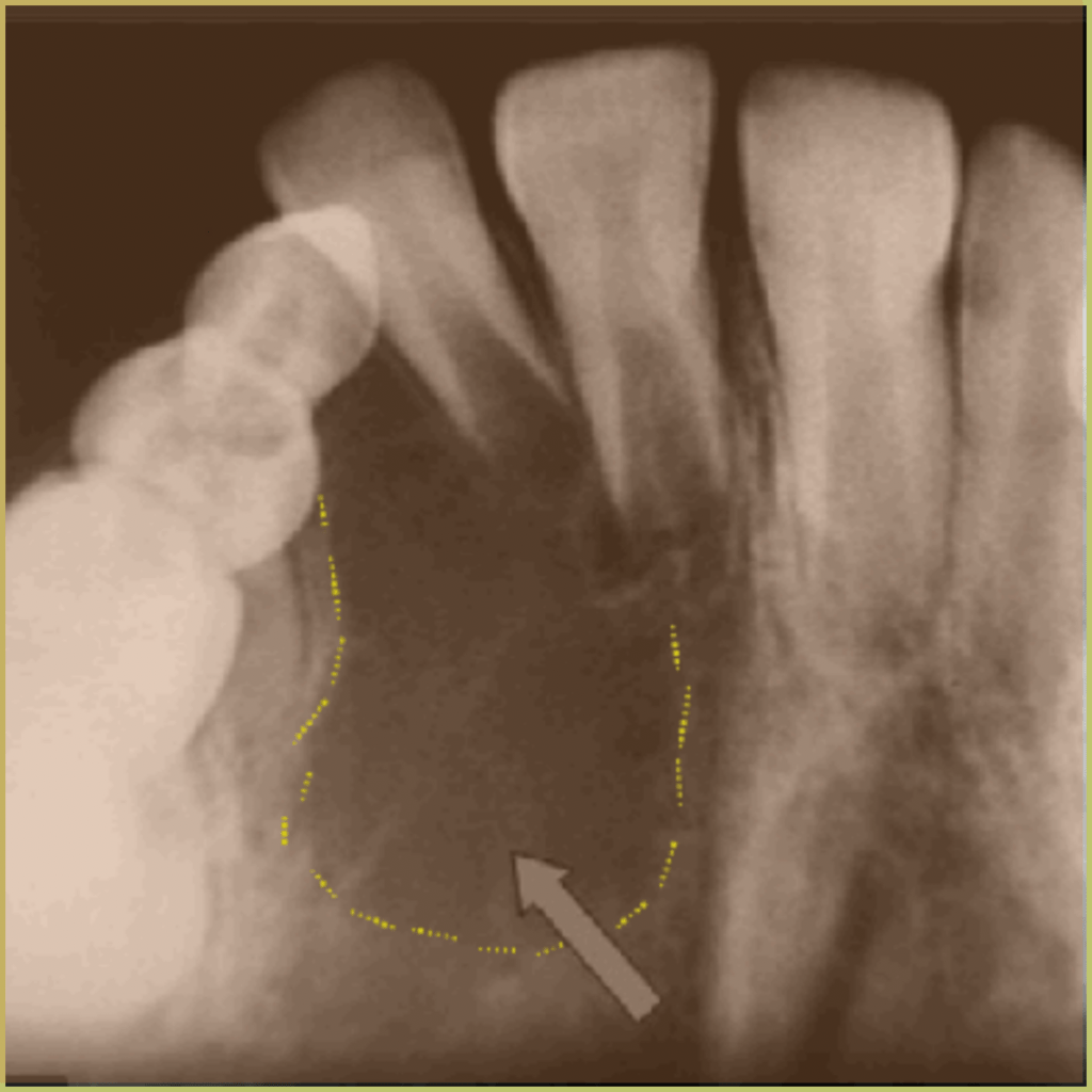 Aneurysmal Bone Cysts 3 1024x1024 1