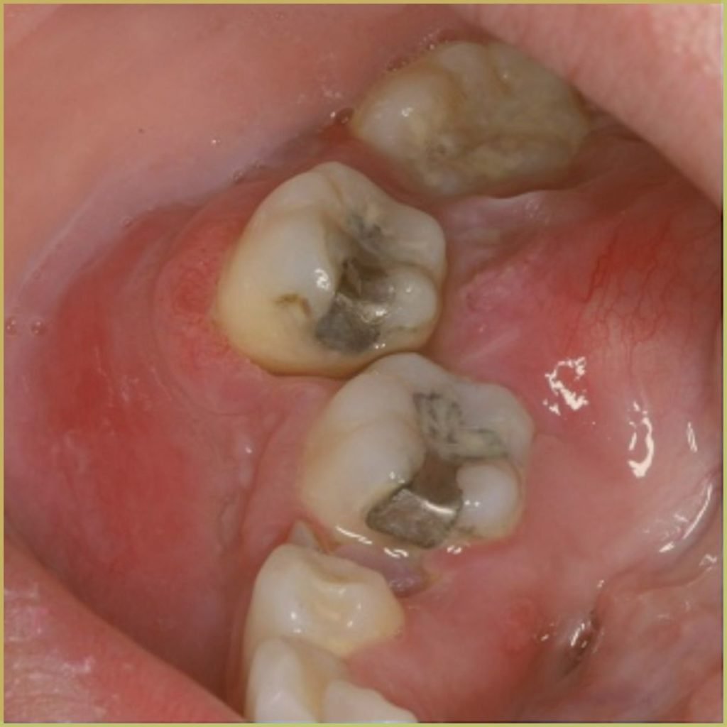 Aneurysmal Bone Cysts 4 1024x1024 1