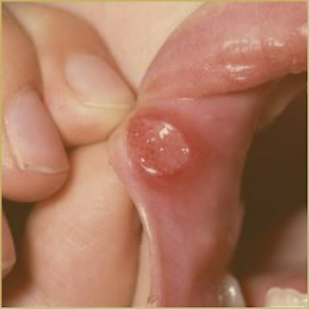 Aphthous Stomatitis 1 1024x1024 1