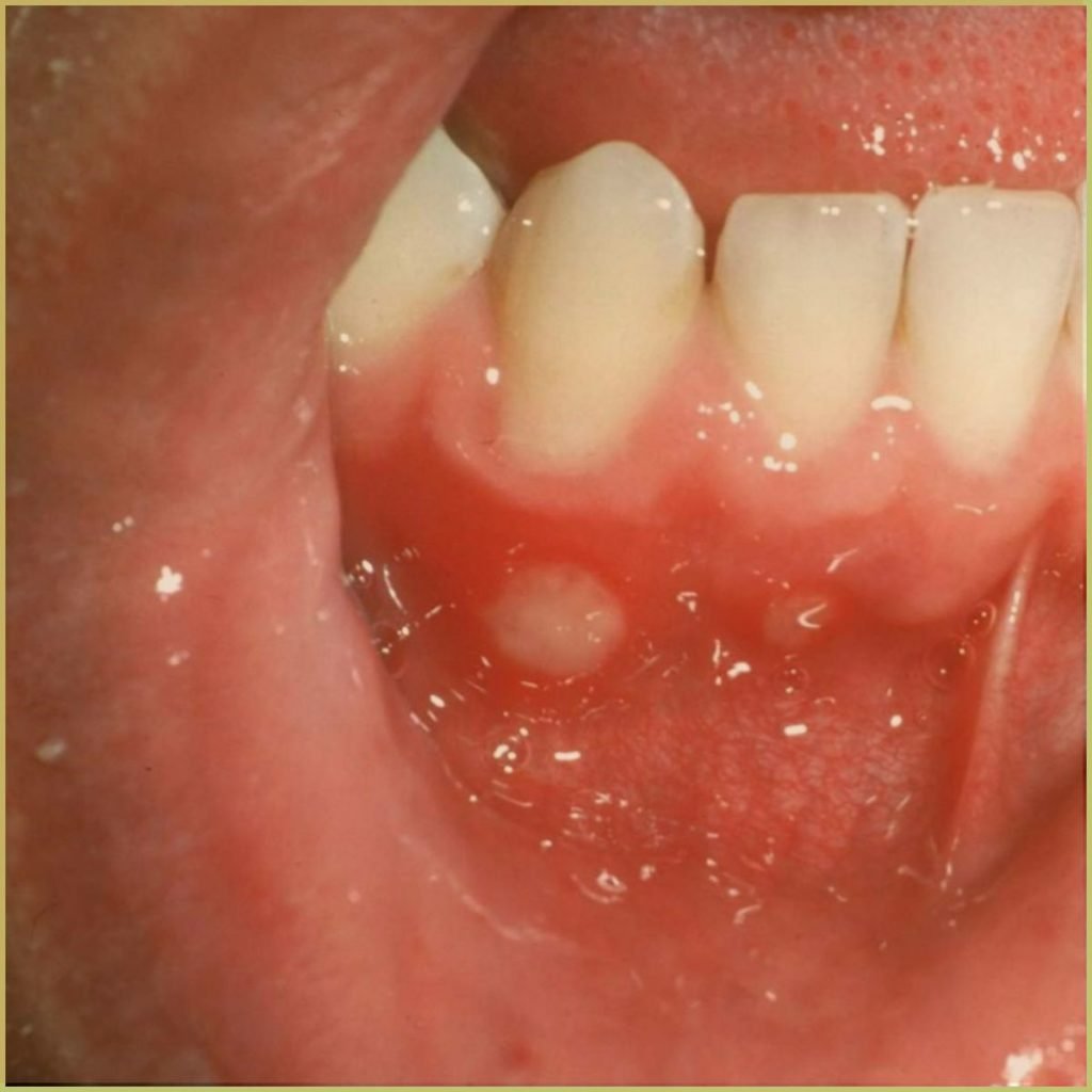 Aphthous Stomatitis 2 1024x1024 1