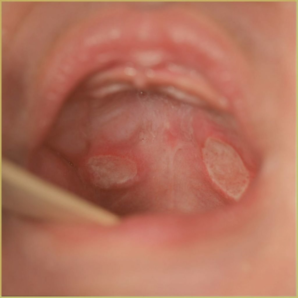 Aphthous Stomatitis 3 1024x1024 1