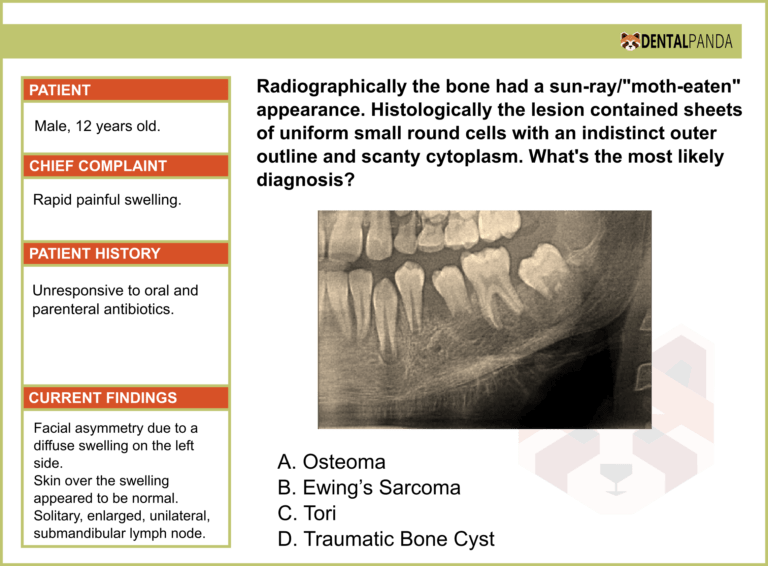 BENIGN NON-ODONTOGENIC TUMORS - Ewing’s Sarcoma