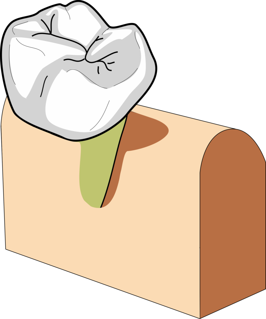 Bony defects 2 wall 854x1024 2