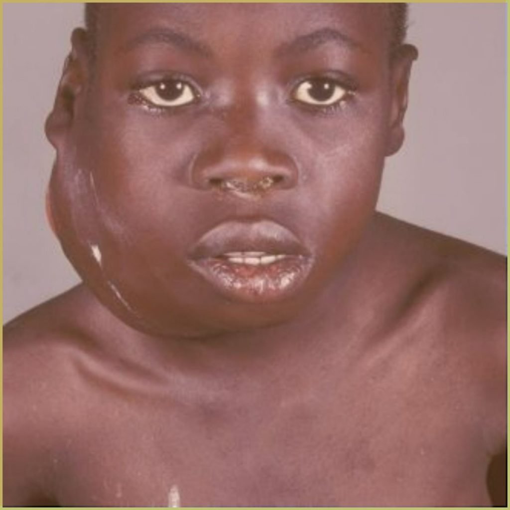 Burkitts Lymphoma 1 1024x1024 1