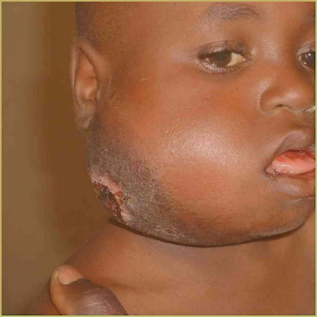 Burkitts Lymphoma 2 1024x1024 1