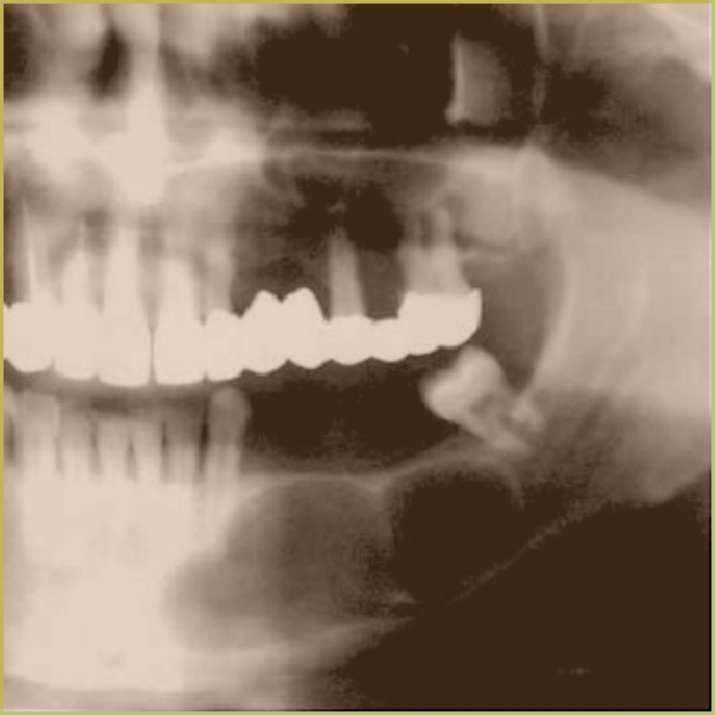 Calcifying Odontogenic Cyst 1 1024x1024 1