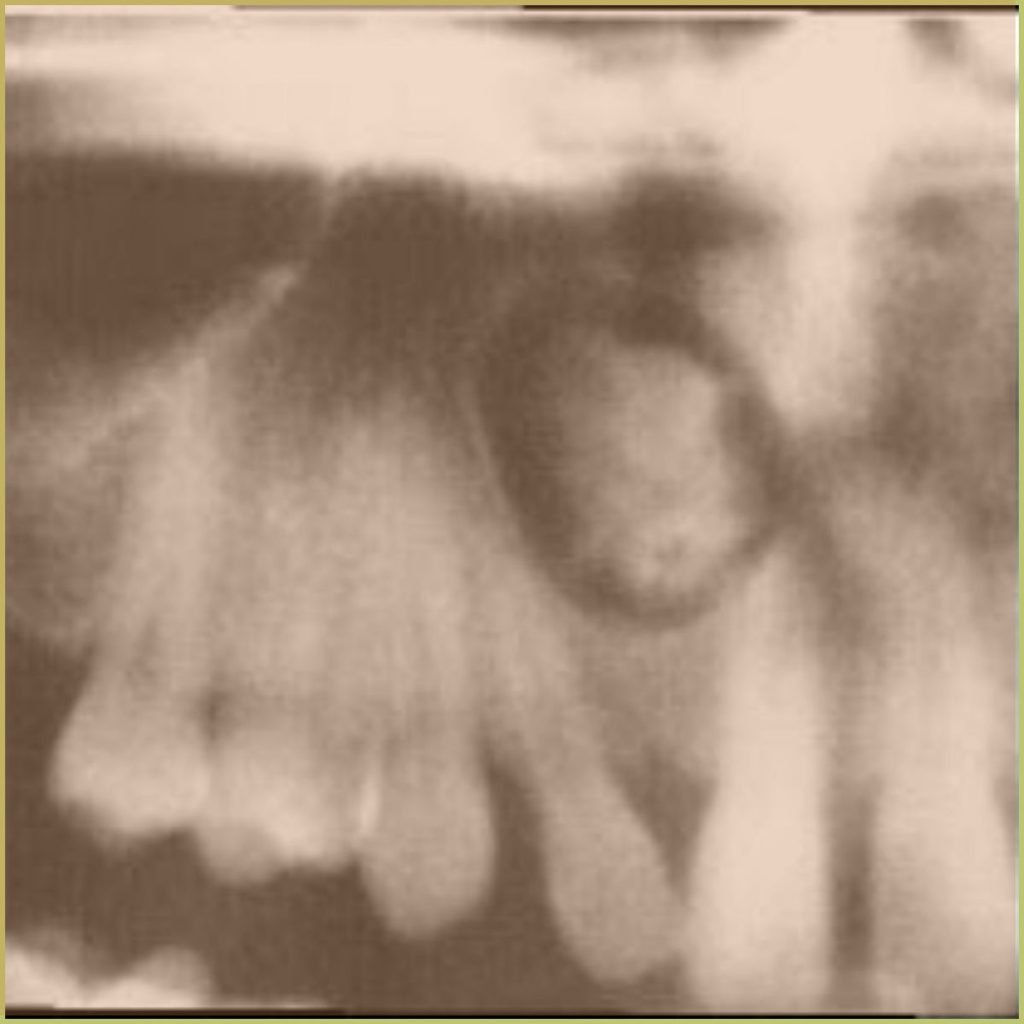 Calcifying Odontogenic Cyst 4 1024x1024 1