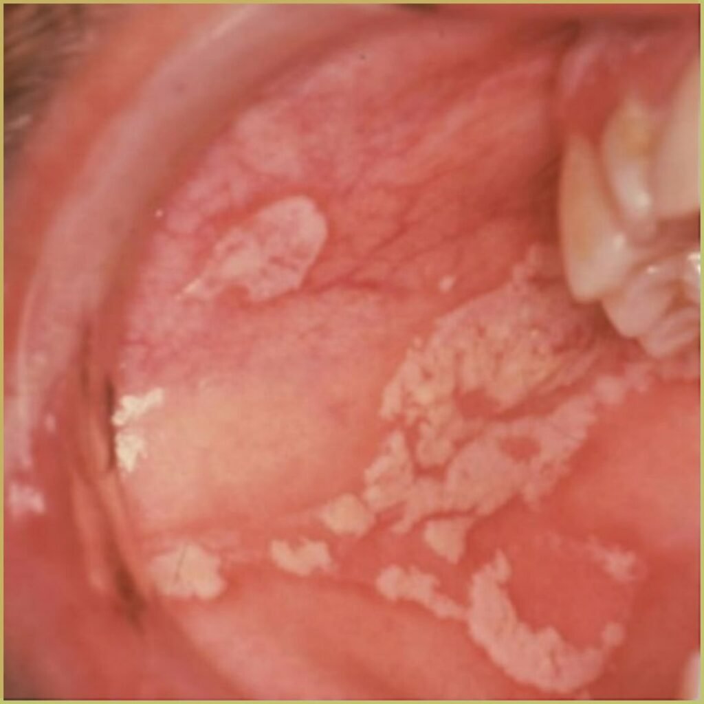 Candidiasis 1 oral thrush 1