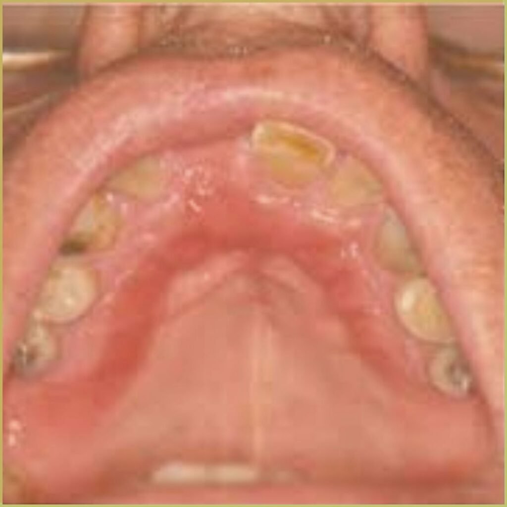 Candidiasis 2 denture sore mouth 1