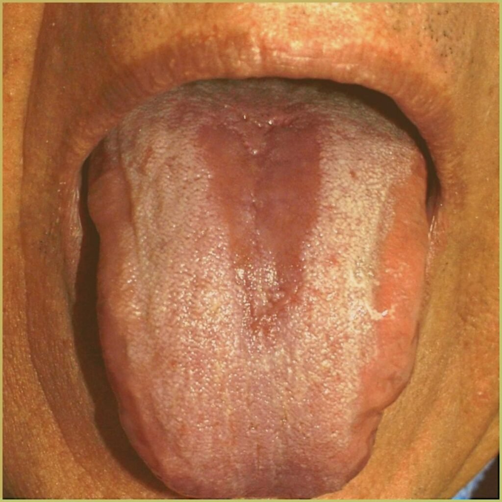 Candidiasis 3 median rhomboid glossitis 1