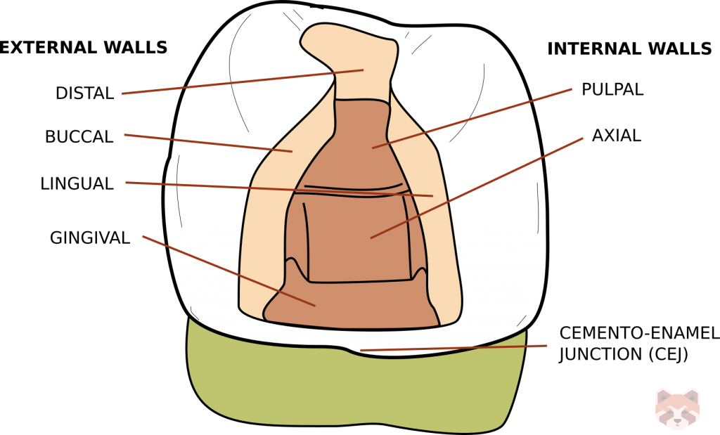 Cavity prep walls 1024x619 1