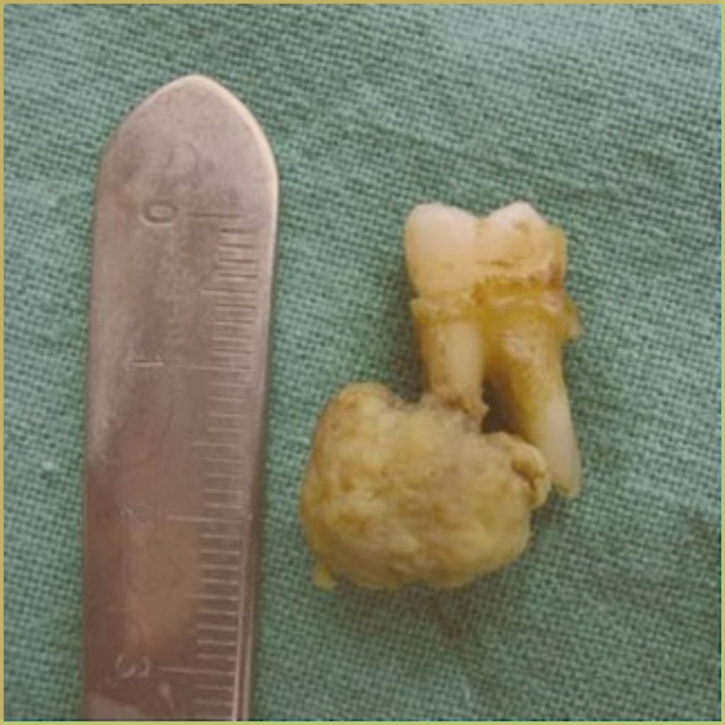 Cementoblastoma 4 1024x1024 1