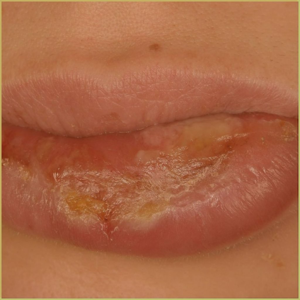Cheilitis Glandularis 1 1024x1024 1