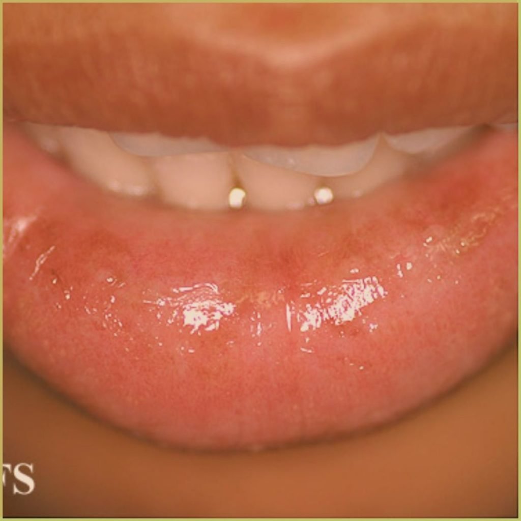 Cheilitis Glandularis 2 1024x1024 1