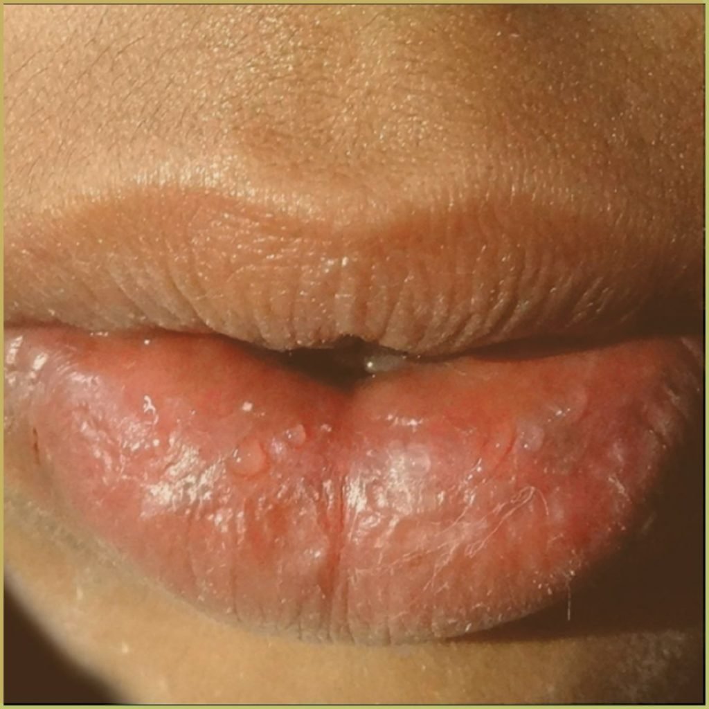 Cheilitis Glandularis 3 1024x1024 1