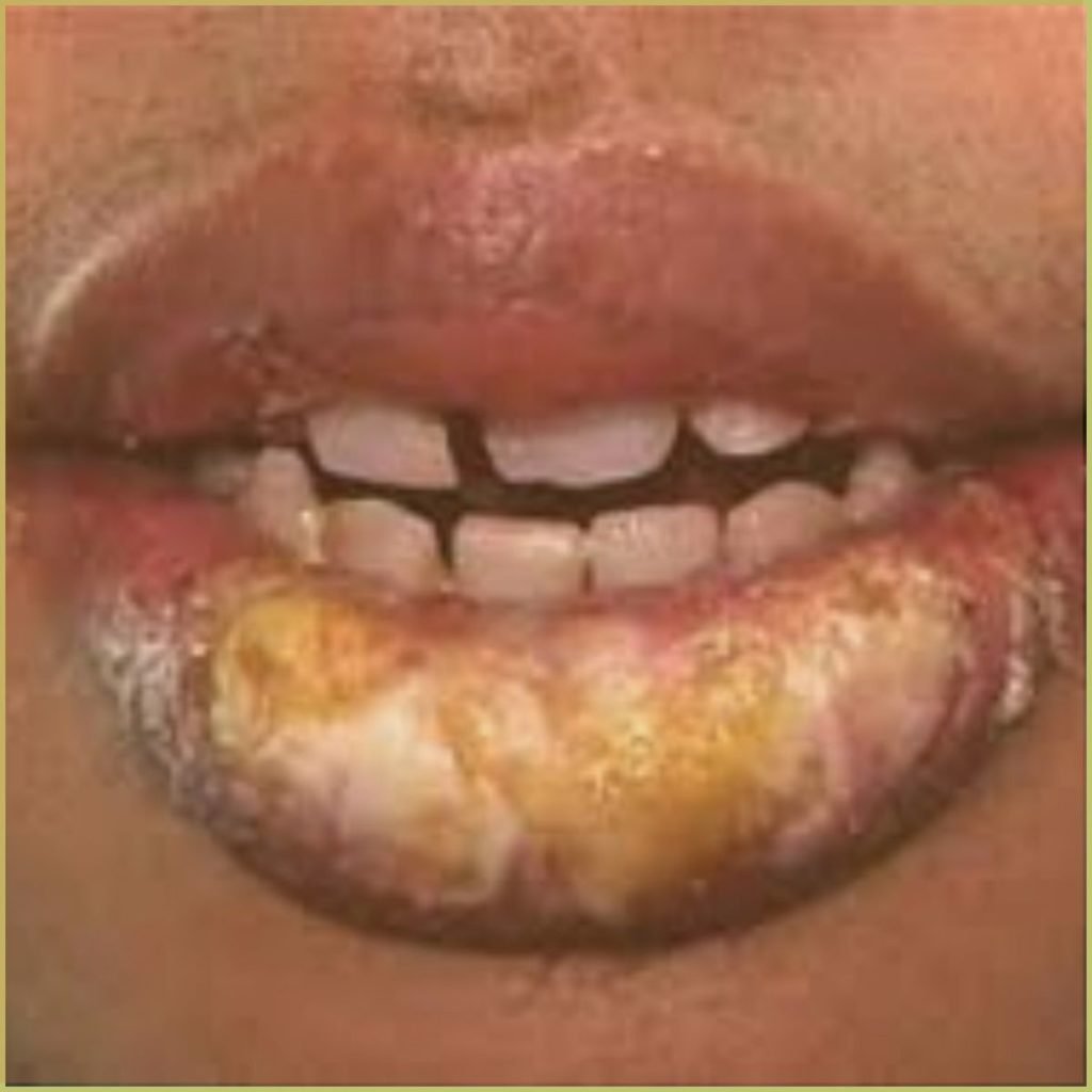 Cheilitis Glandularis 4 1024x1024 1