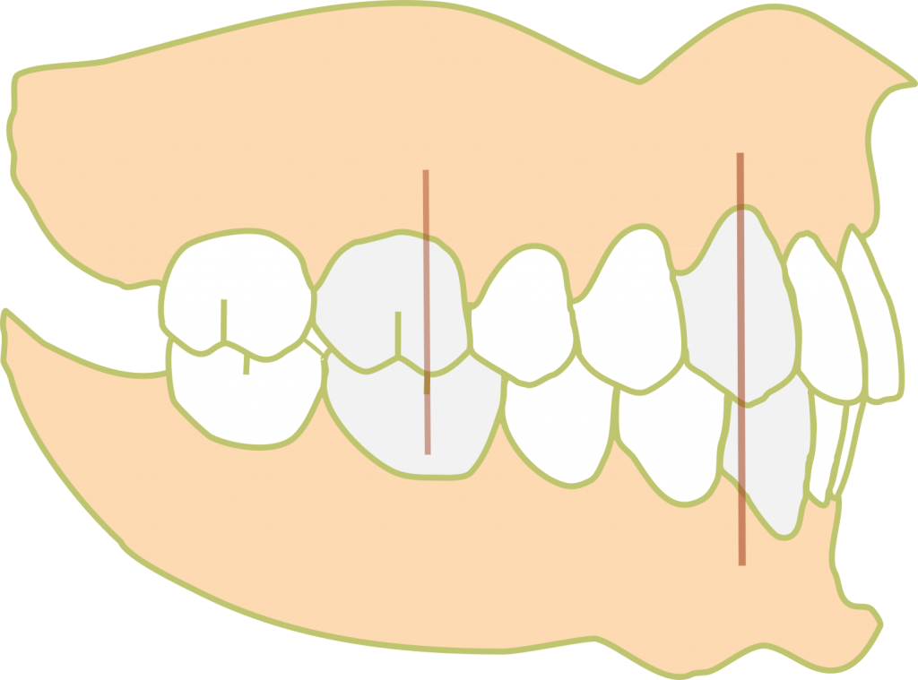 Class I molar 1024x759 1