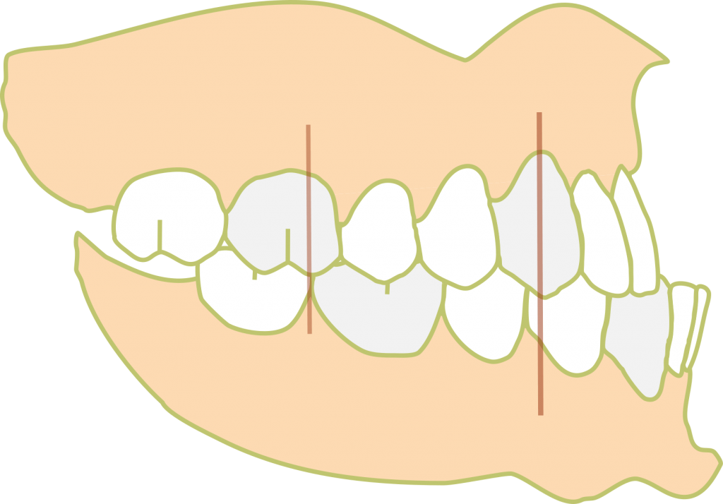 Class III molar 1024x714 1