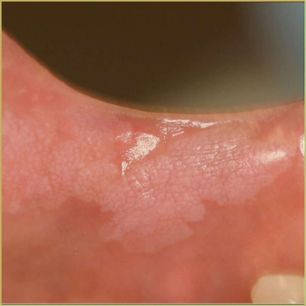 Condyloma Acuminatum 3 1024x1024 1
