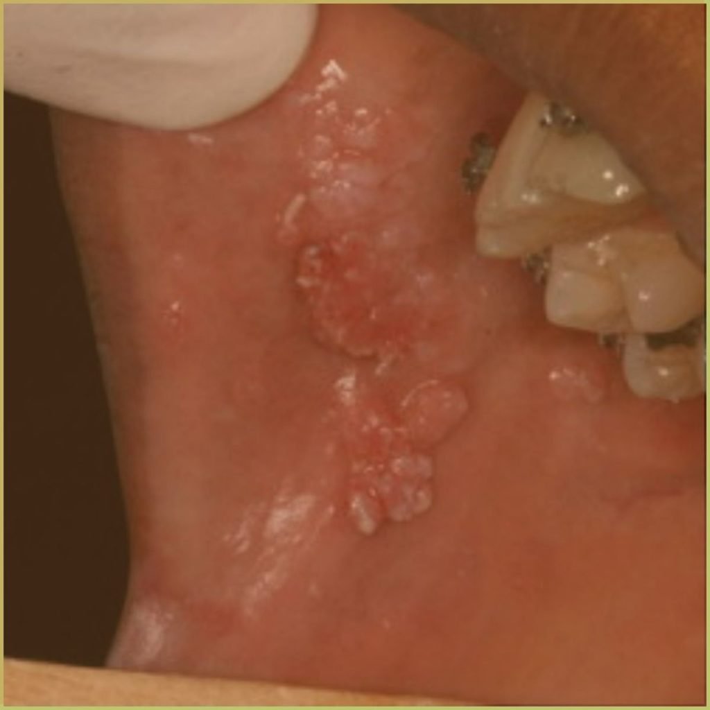 Condyloma Acuminatum 4 1024x1024 1