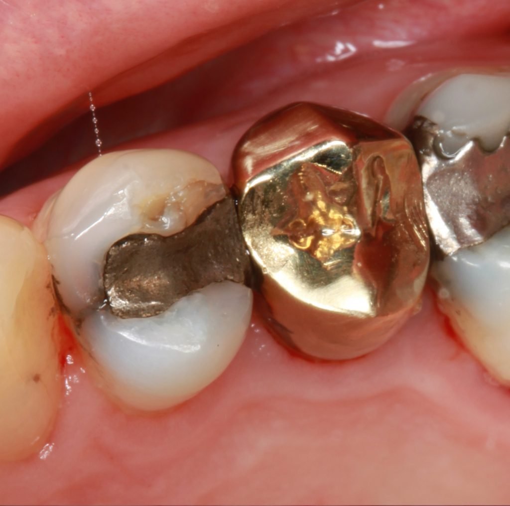 Cracked tooth 1 1024x1016 1