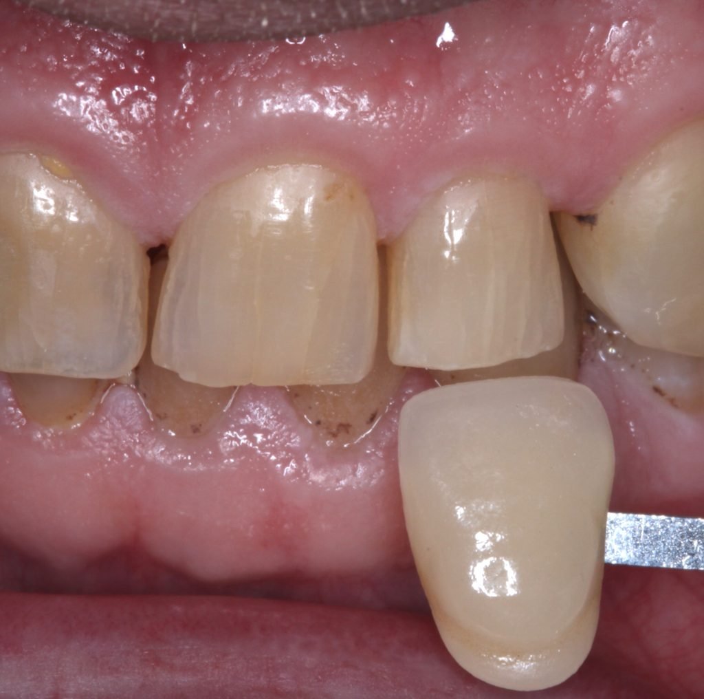 Cracked tooth 2 1024x1016 1